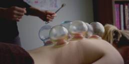 Cupping Chinese Medicine